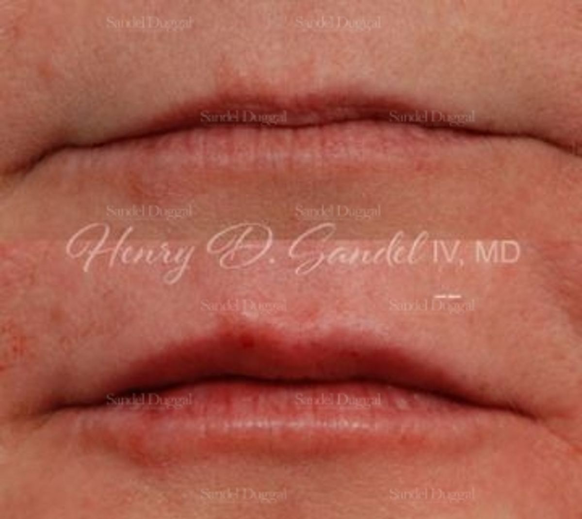 Lip Augmentation / Lip Lift before and after, case 4401