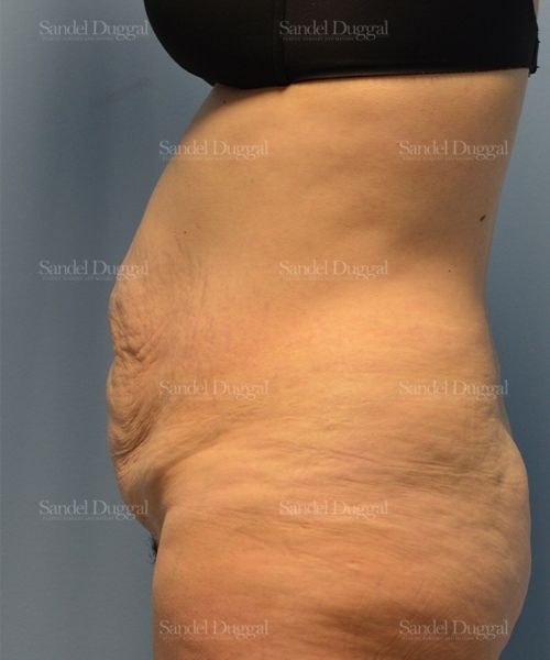 Tummy Tuck before, case 1722