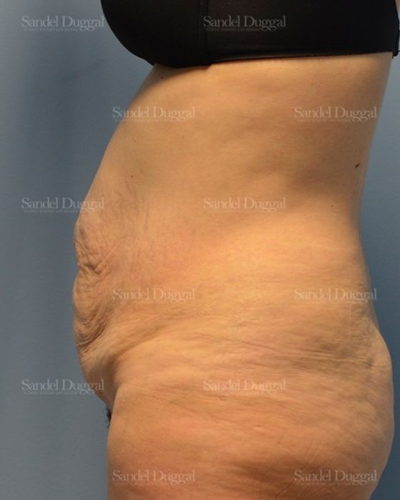 Tummy Tuck before, case 1722