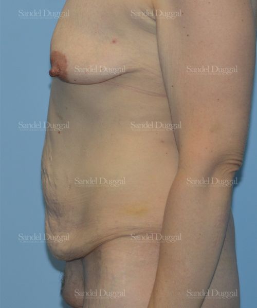 Tummy Tuck before, case 1615