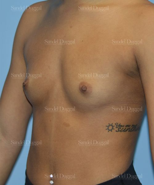 Breast Augmentation before, case 3164