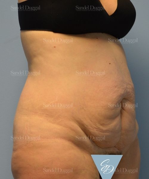 Tummy Tuck before, case 1722