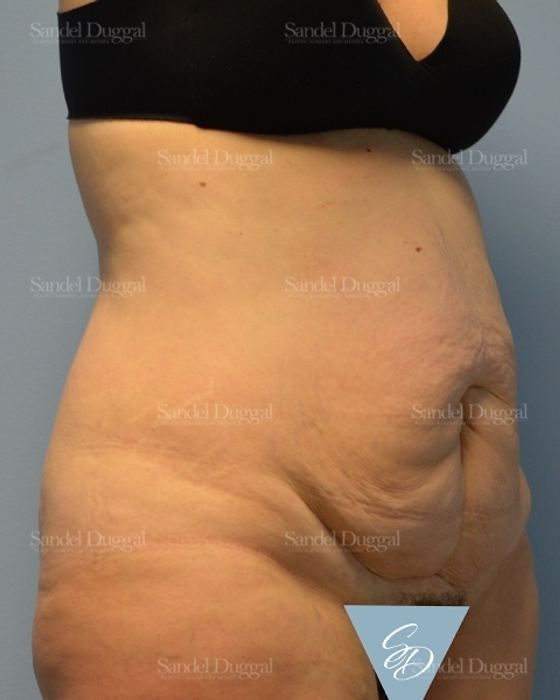 Tummy Tuck before, case 1722
