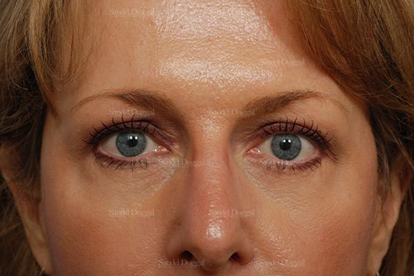 Eyelid Rejuvenation after, case 824