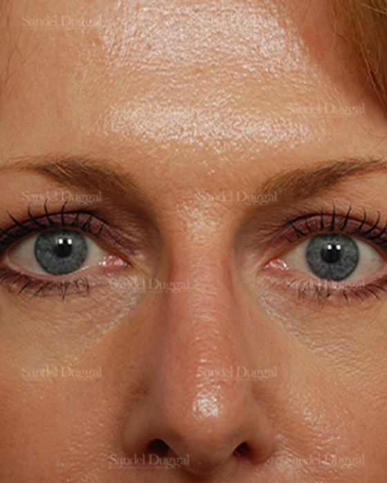 Eyelid Rejuvenation after, case 824