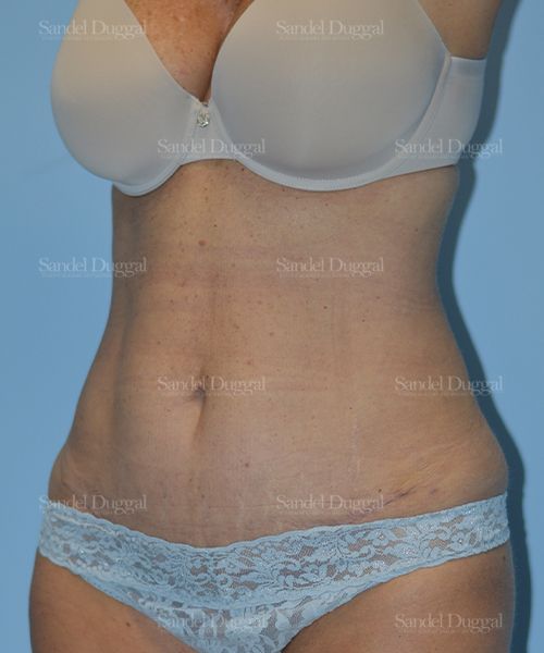 Tummy Tuck after, case 1599