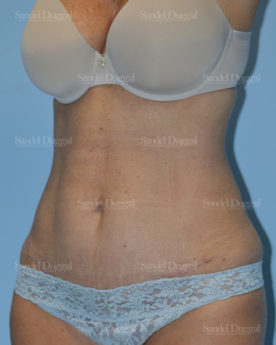 Tummy Tuck after, case 1599