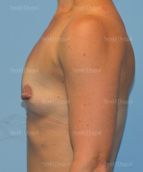 Breast Augmentation before, case 3115