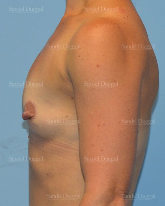 Breast Augmentation before, case 3115