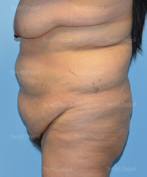 Tummy Tuck before, case 1547