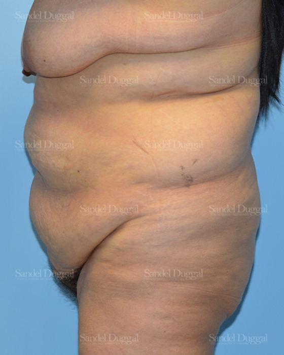Tummy Tuck before, case 1547