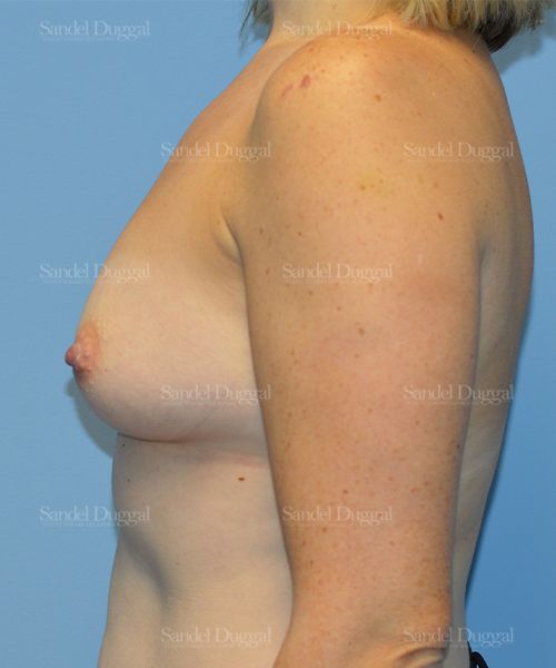 Breast Augmentation before, case 3192