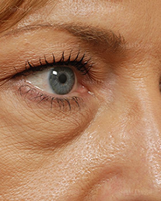 Eyelid Rejuvenation before, case 824