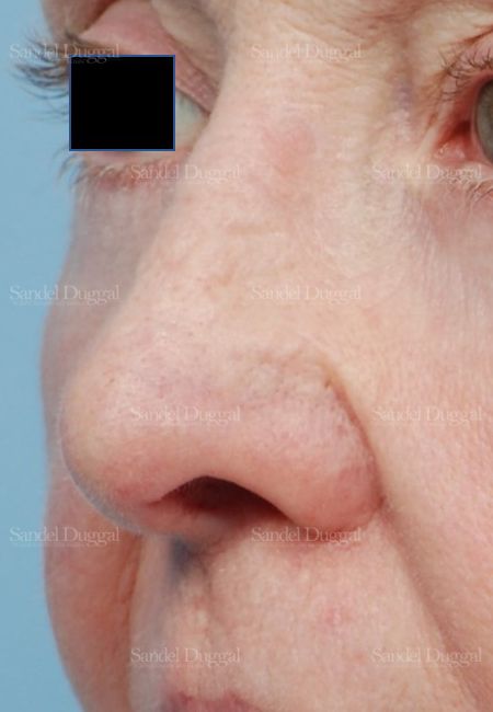 Revision Rhinoplasty after, case 2614