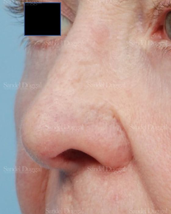 Revision Rhinoplasty after, case 2614