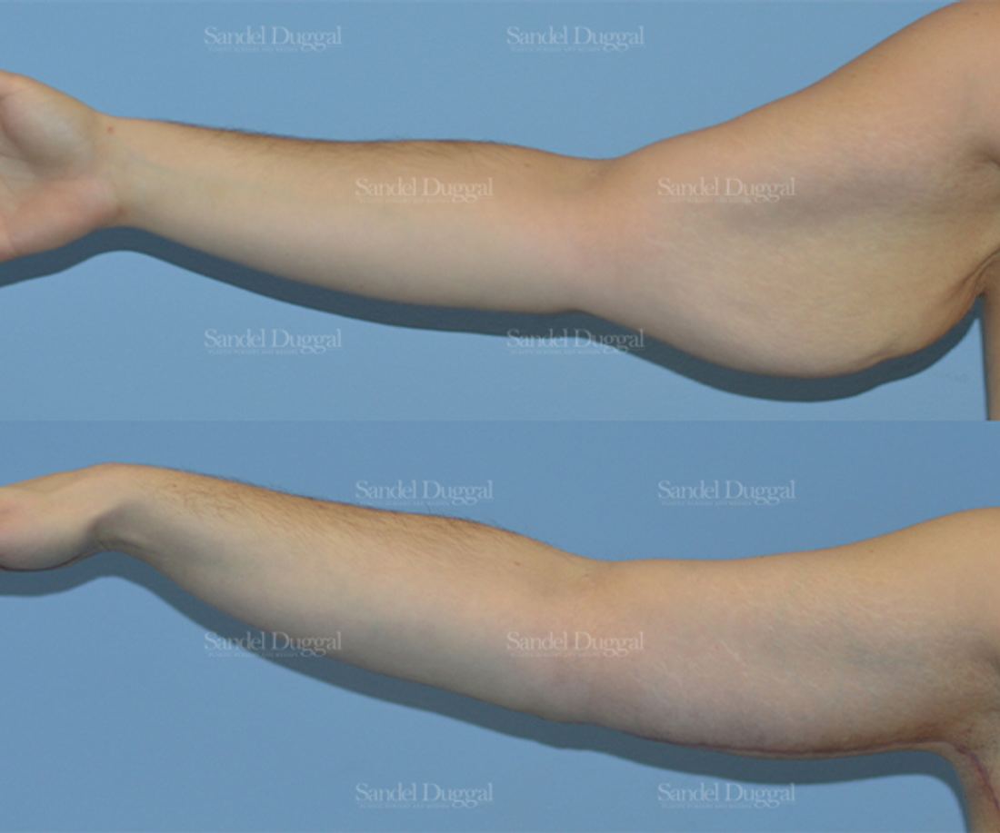 Brachioplasty before and after, case 2156