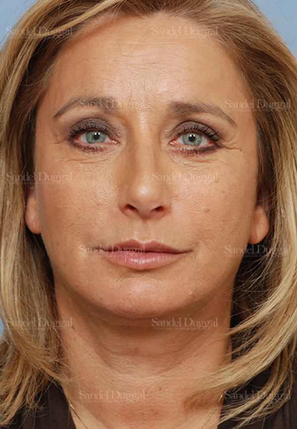 Facelift after, case 2714