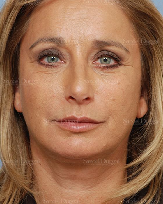Facelift after, case 2714