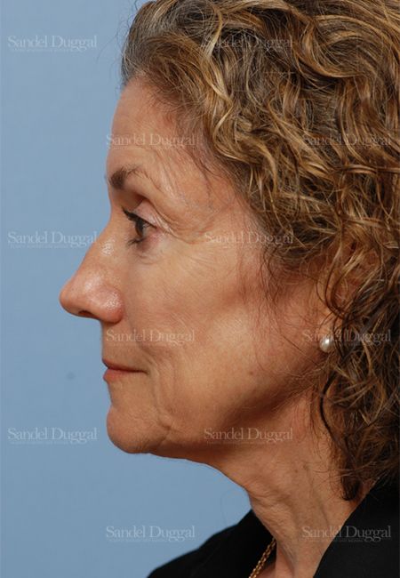 Rhinoplasty before, case 2845