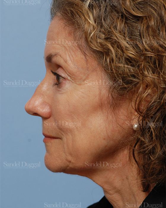 Rhinoplasty before, case 2845