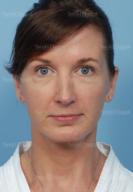 Facelift after, case 2647