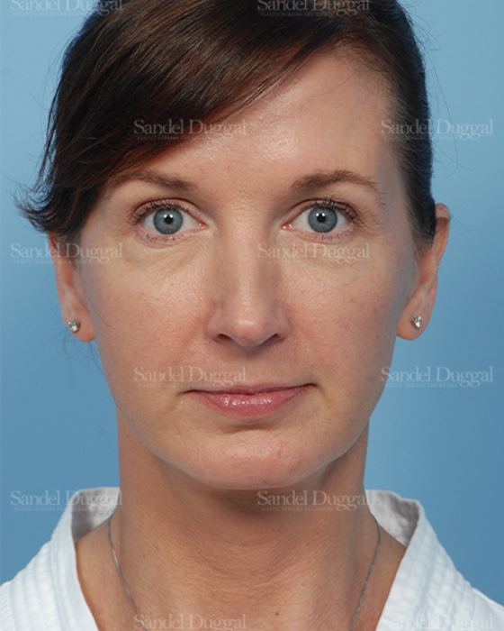 Facelift after, case 2647