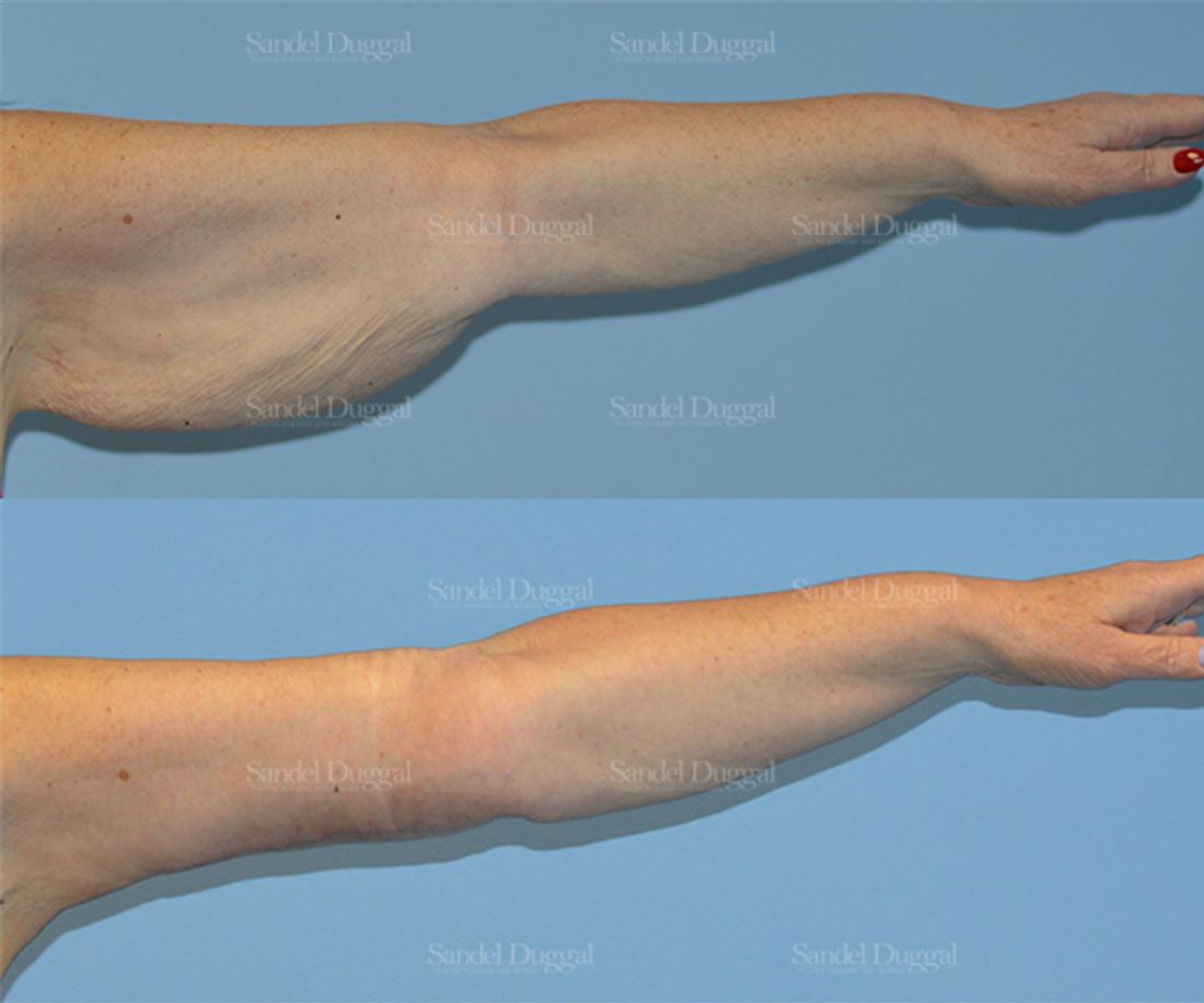 Brachioplasty before and after, case 2139