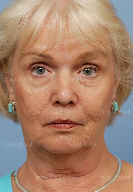 Facelift before, case 2680
