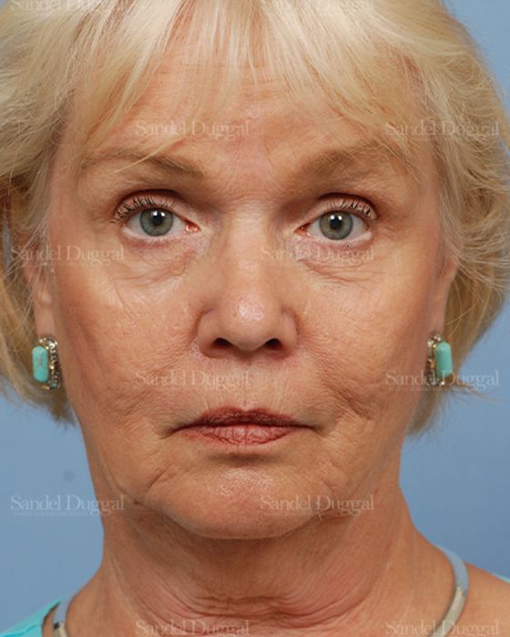 Facelift before, case 2680