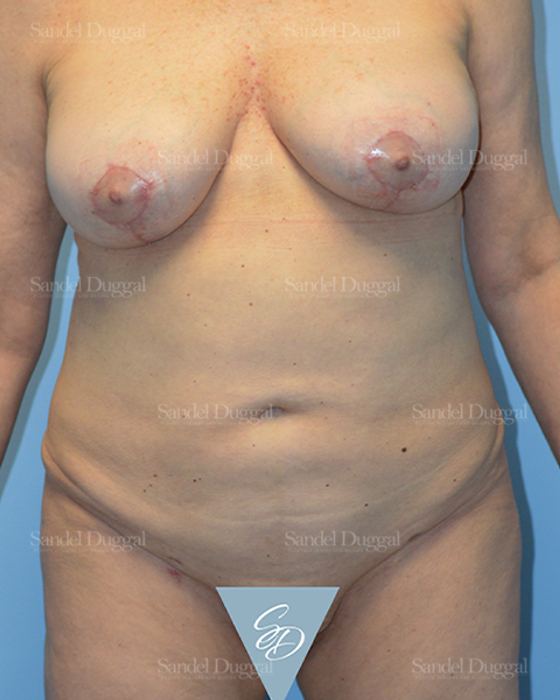 Liposuction — Abdomen after, case 2448
