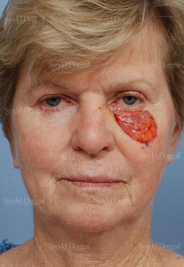 Reconstruction after Mohs before, case 2739