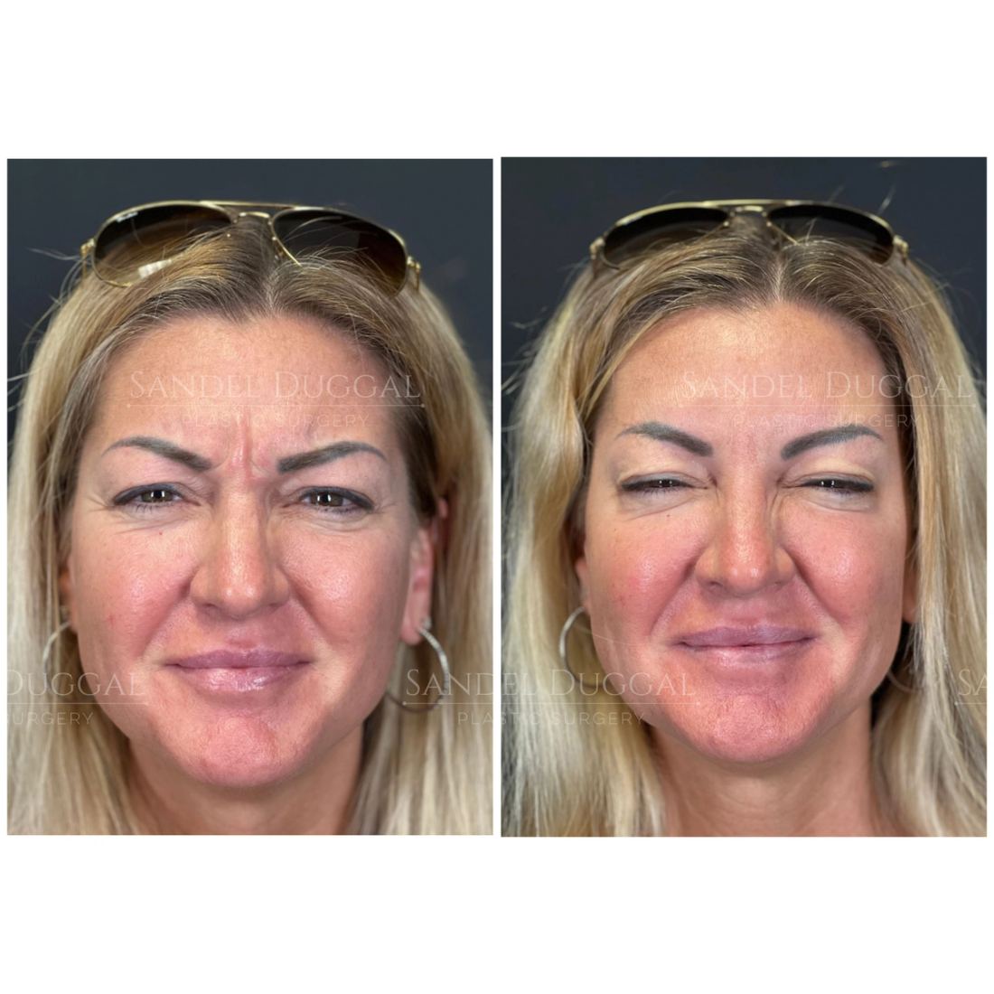 Botox & Fillers before and after, case 6010