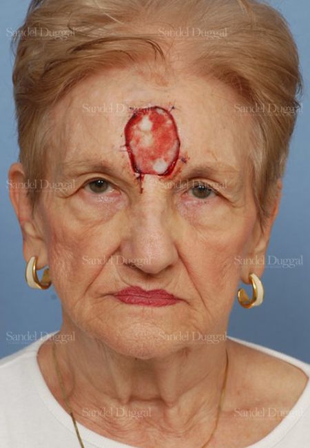 Reconstruction after Mohs before, case 2757
