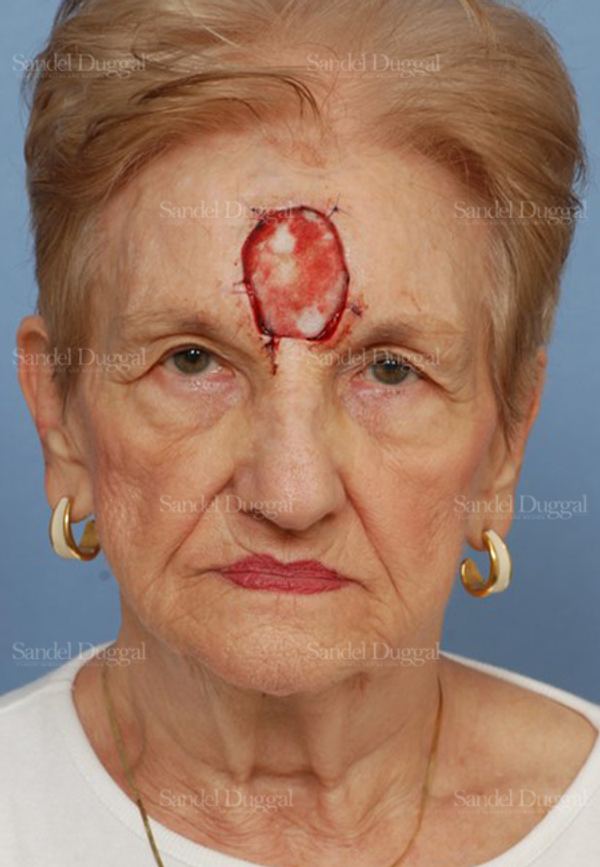 Reconstruction after Mohs before, case 2757