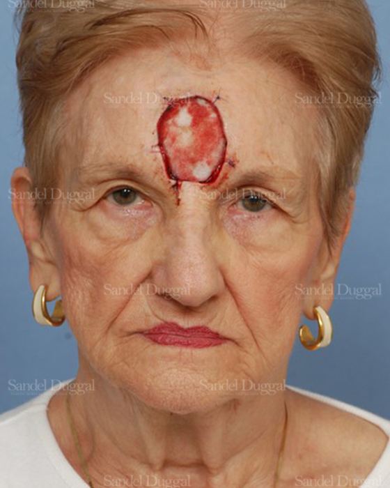 Reconstruction after Mohs before, case 2757