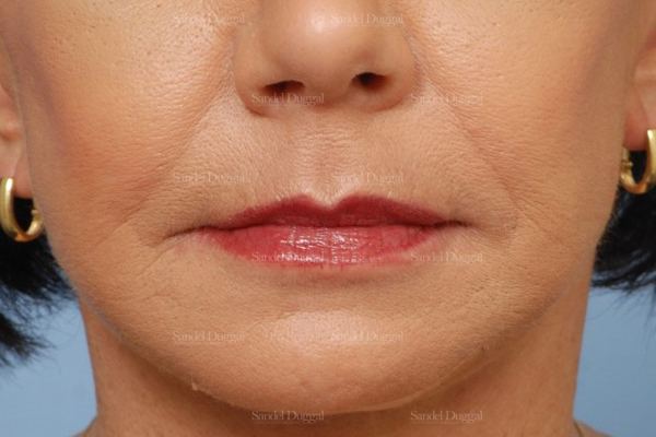 Botox & Fillers after, case 2588