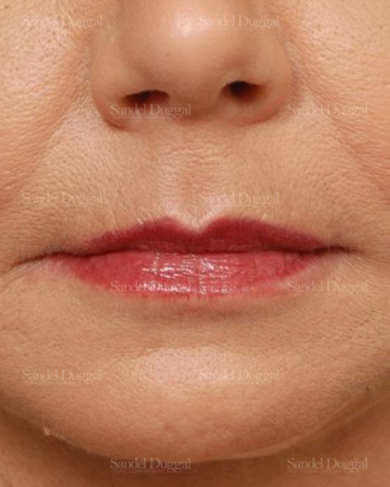 Botox & Fillers after, case 2588