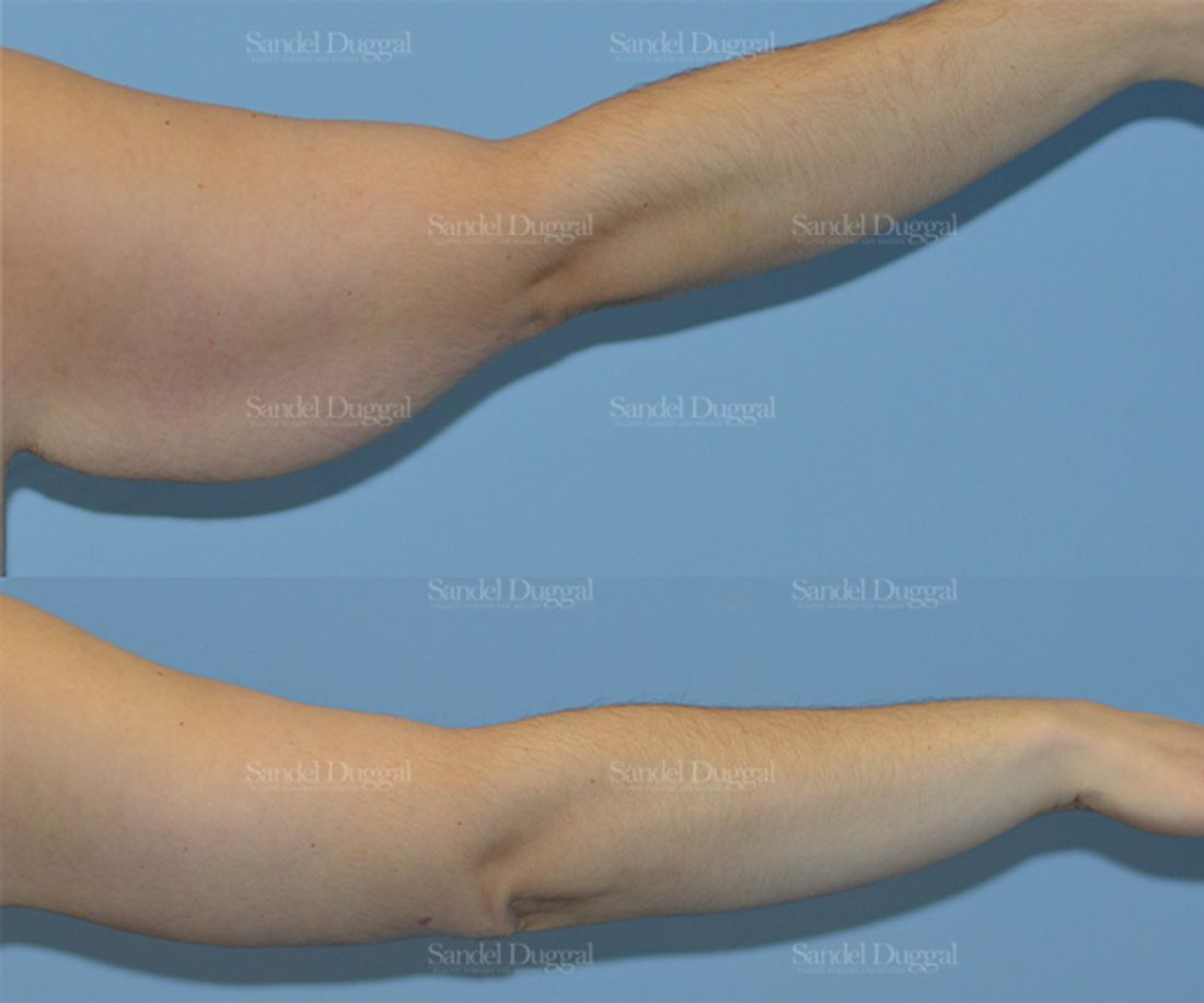 Brachioplasty before and after, case 2156