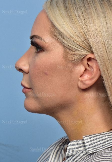 Neck & Chin Liposuction after, case 5315