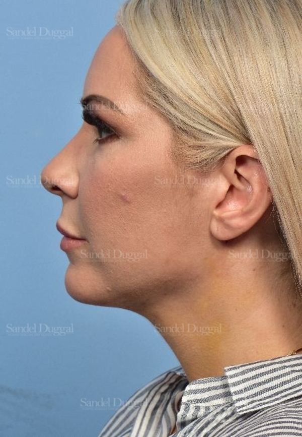 Neck & Chin Liposuction after, case 5315