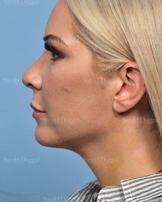 Neck & Chin Liposuction after, case 5315