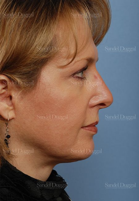 Facelift after, case 806