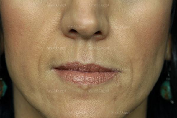 Botox & Fillers before, case 2585