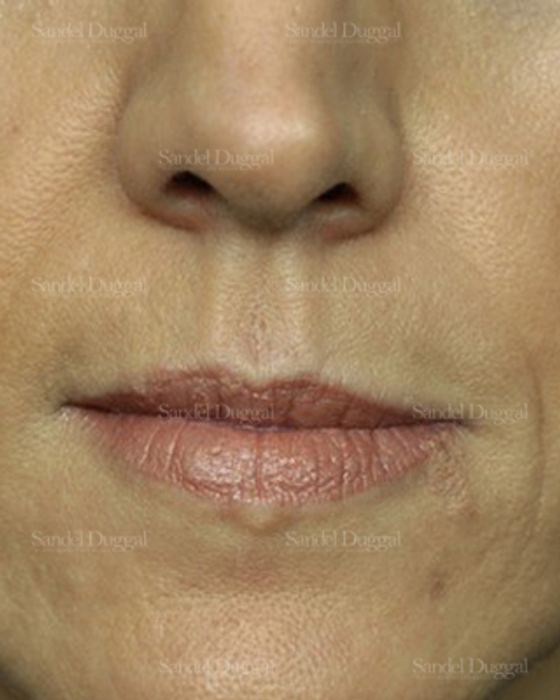 Botox & Fillers before, case 2585