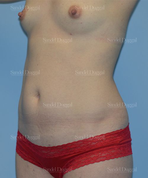 Tummy Tuck before, case 1554