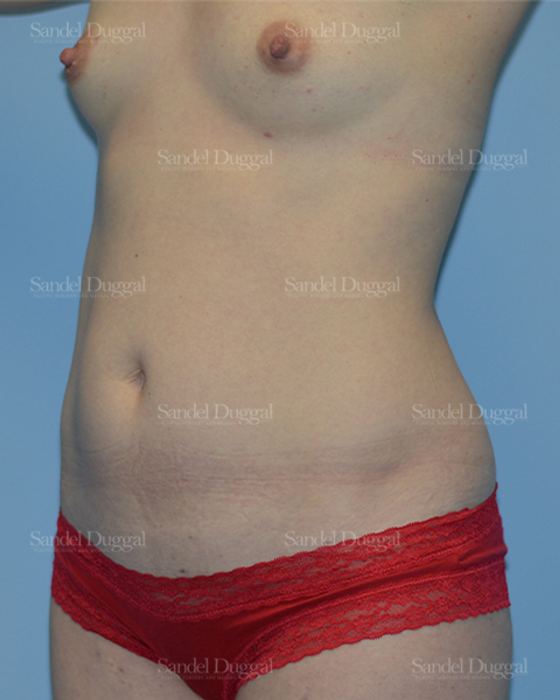 Tummy Tuck before, case 1554