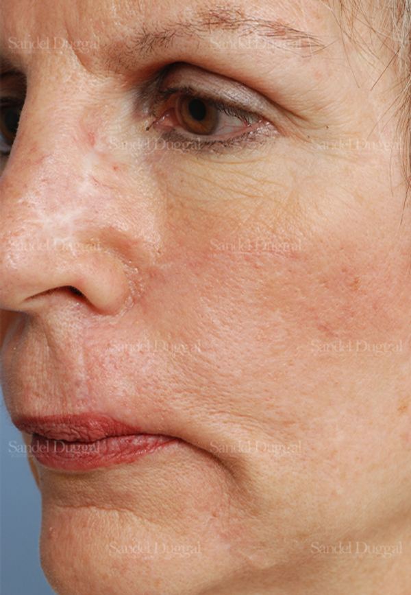 Reconstruction after Mohs after, case 2769