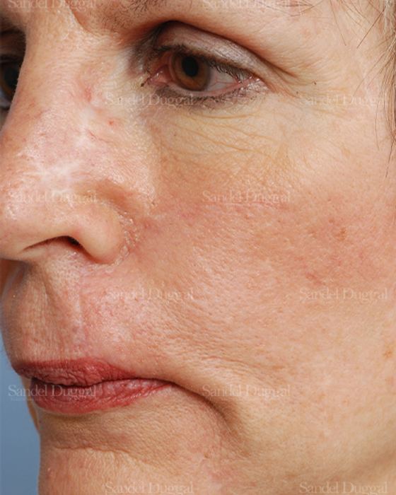 Reconstruction after Mohs after, case 2769