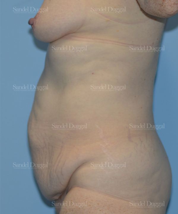 Tummy Tuck before, case 1519