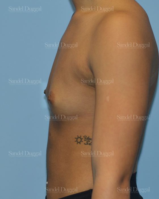 Breast Augmentation before, case 3164